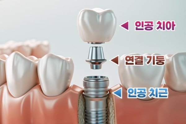 임플란트 구조